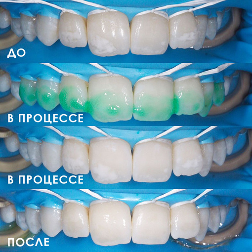 Лечение зубов по методике ICON <br>в Клинике Здоровья Исток