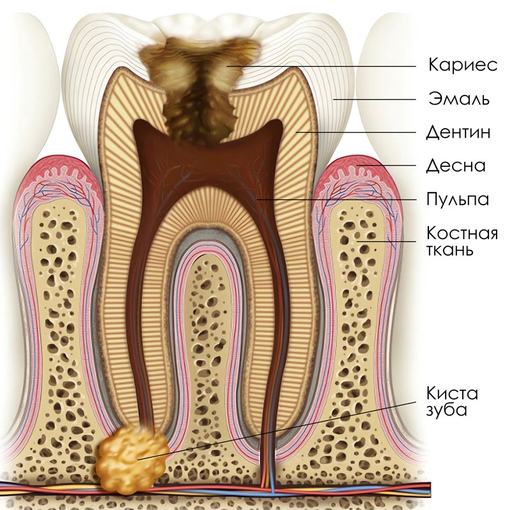 Лечение кисты зубов
