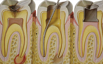 Сломанный инструмент в зубном канале – как спасти зуб от удаления?