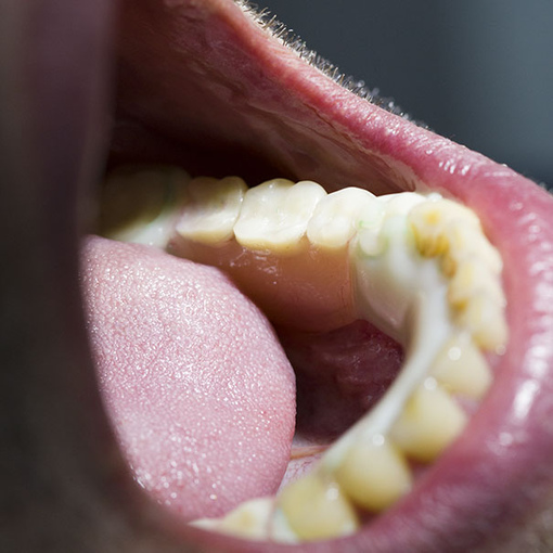 Протезирование зубов (ортопедия)