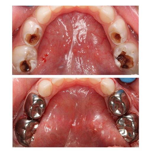 Коронки на молочные зубы: польза и вред
