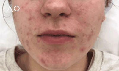Аппаратная диагностика кожи лица это