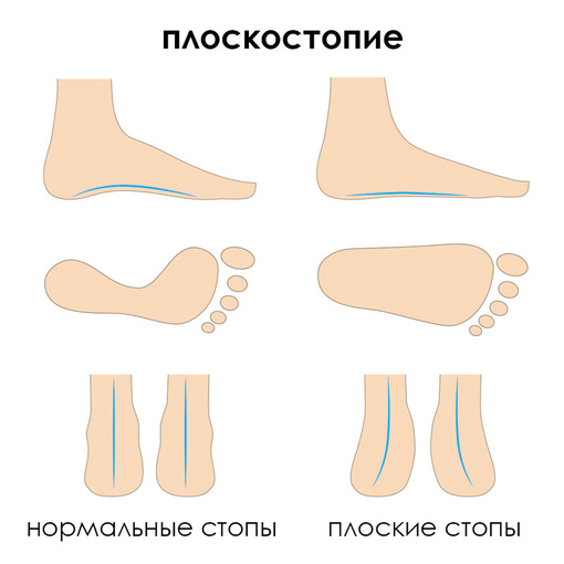 Плоскостопие: нормальные и плоские стопы