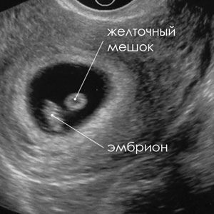 УЗИ диагностика ранних сроков беременности