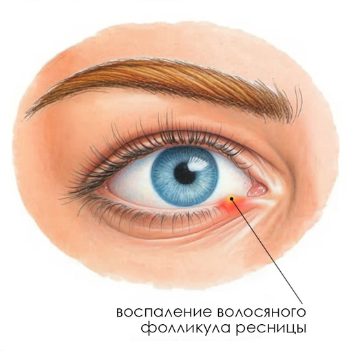 Глазные капли от ячменя