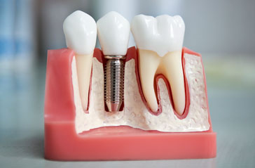 Если существует риск отторжения зубных имплантов