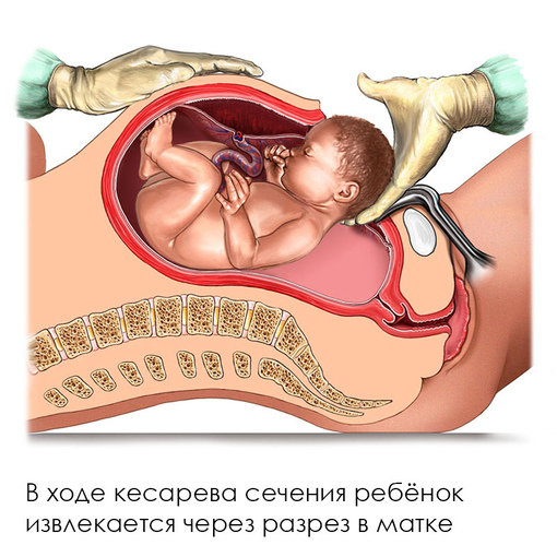 Причины родовых дисфункций <br>и травм после кесарева сечения