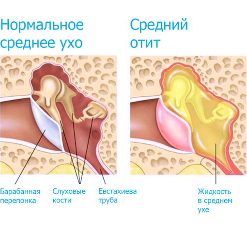 При отите шумит в ухе: причины, симптомы, лечение