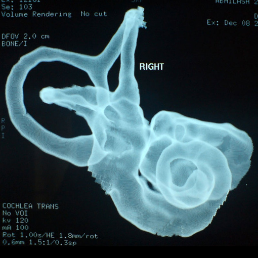 Конусно-лучевая томография височных костей и внутреннего уха