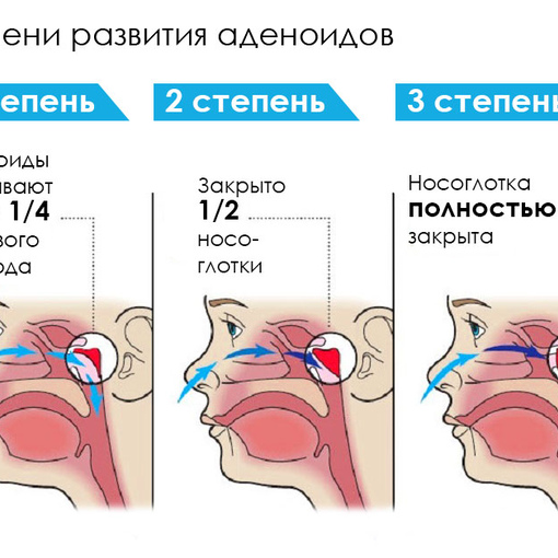 Причины гипертрофии носоглоточной миндалины