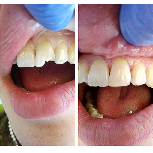 Какую пломбу лучше поставить на передний зуб?