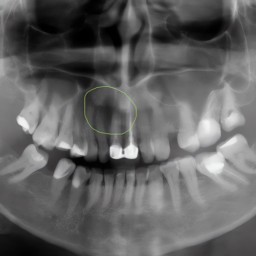 Киста зуба - симптомы и лечение кистозного образования.