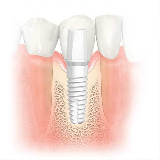 Одноэтапная имплантация (зубы за один день)