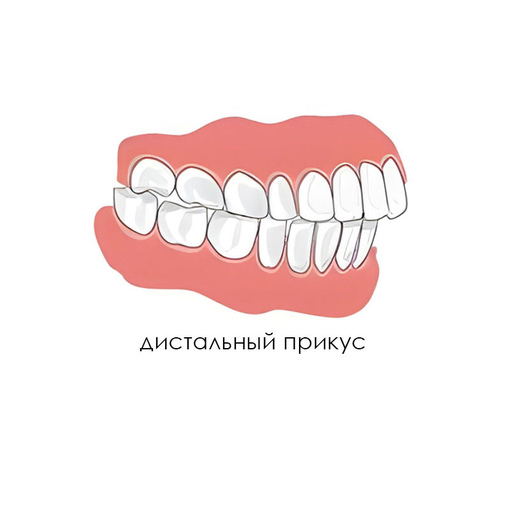 2. Дистальный (прогнатический) <br>прикус