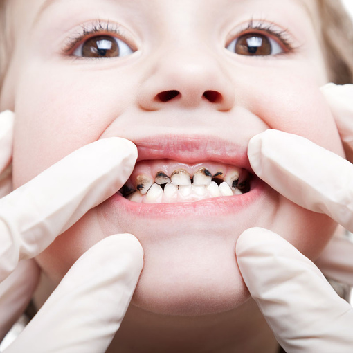 Почему темнеют зубы у детей
