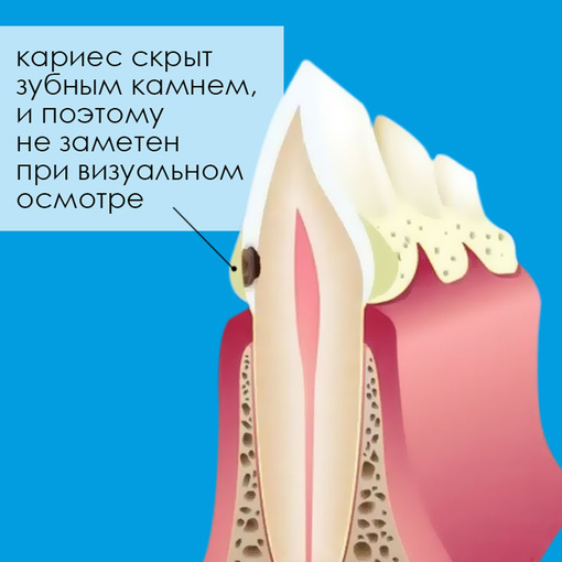 Зубной камень не позволяет обнаружить скрытый кариес