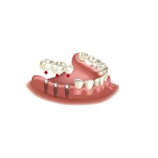 Имплантация зубов. Что это такое?