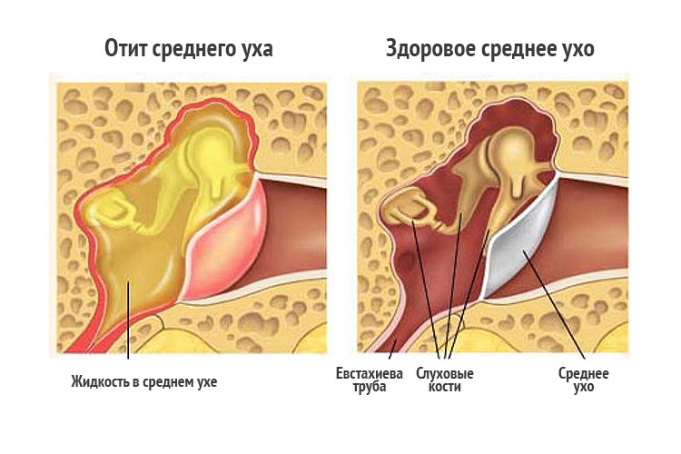 Диагностика грибкового заболевания уха