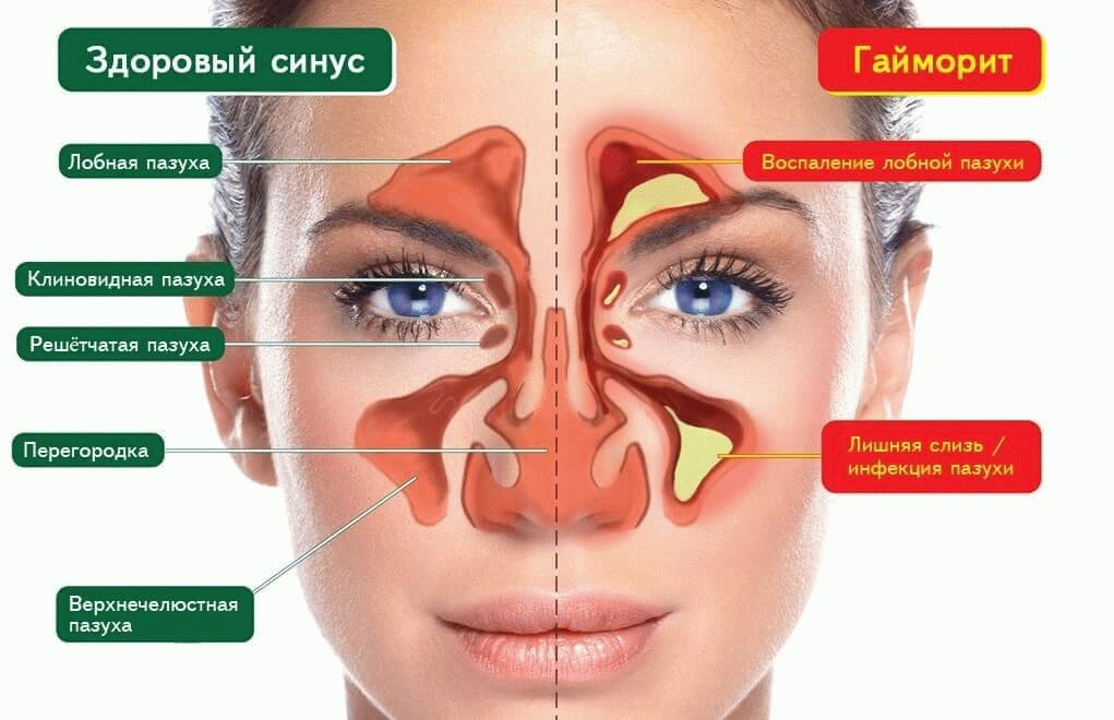 Связь заложенности носа и головной боли